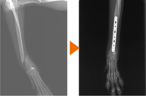 橈骨遠位斜骨折のレントゲンBefore/After