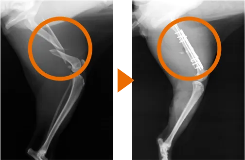 左大腿骨分節骨折のレントゲンBefore/After