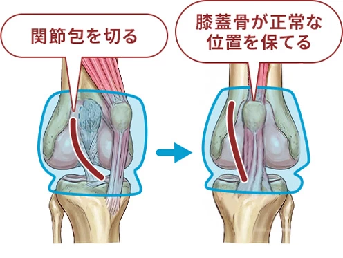 外側関節包の縫縮の図解