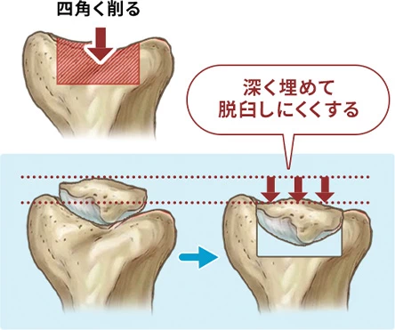 滑車造溝術の図解