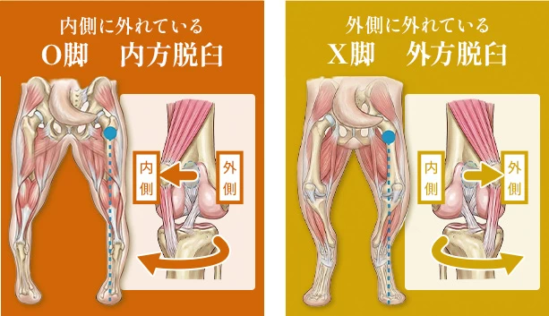 内方脱臼と外方脱臼の図